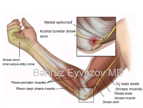 Kubital Tunel Sİndromu