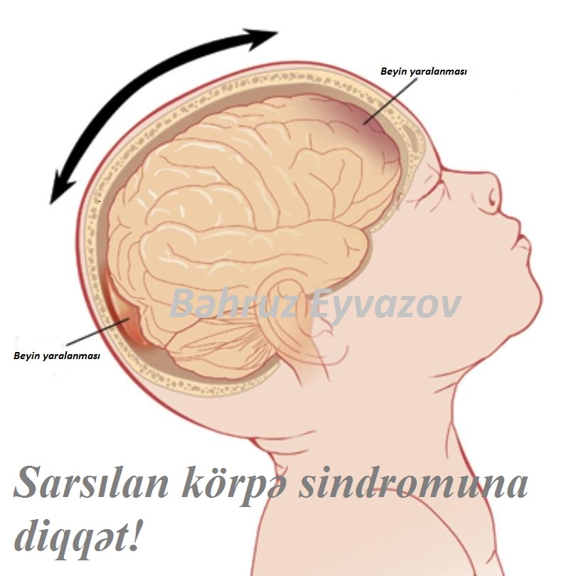 Sarsılan körpə sindromuna diqqət!