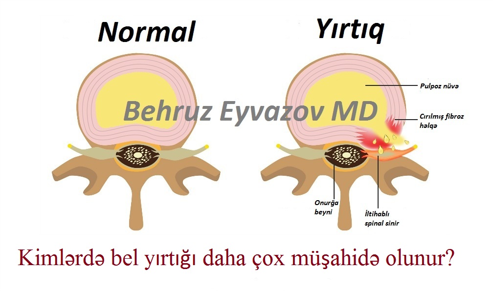 Kimlərdə bel yırtığı daha çox müşahidə olunur?