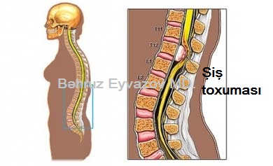 Spinal meningioma