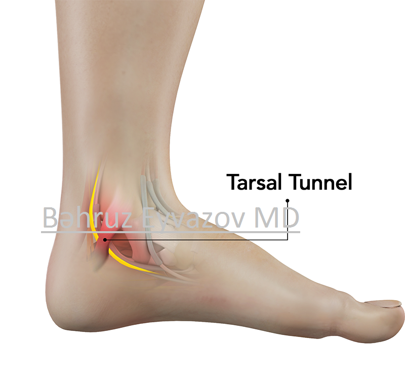 Tarsal tunel sindromu