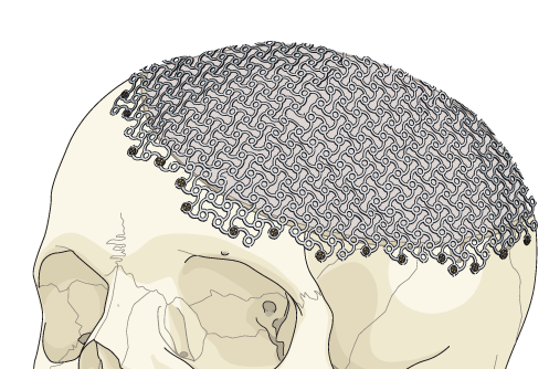 Titan lövhə(Titanium Mesh) ilə Sümük defektinin Kranioplastikası