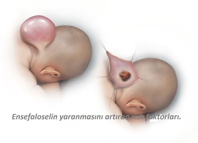Ensefaloselin yaranmasını artıran risk faktorları.