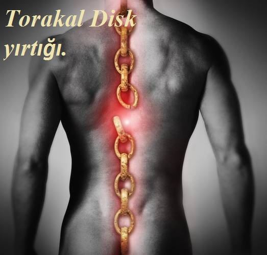 Torakal Disk yırtığı.