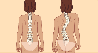 Skolioz deformasiyası niyə müalicə edilməlidir