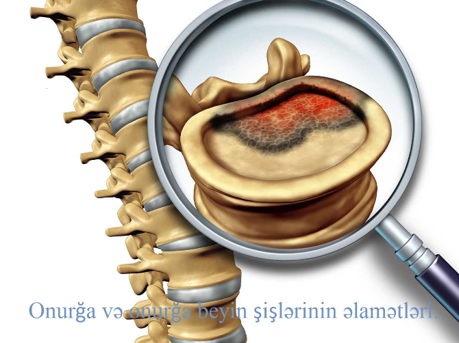 Onurğa və onurğa beyin şişlərinin əlamətləri.