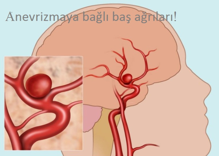 ANEVRİZMAYA BAĞLI BAŞ AĞRILARI!