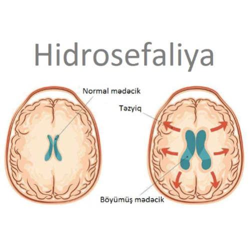 Hidrosefaliya