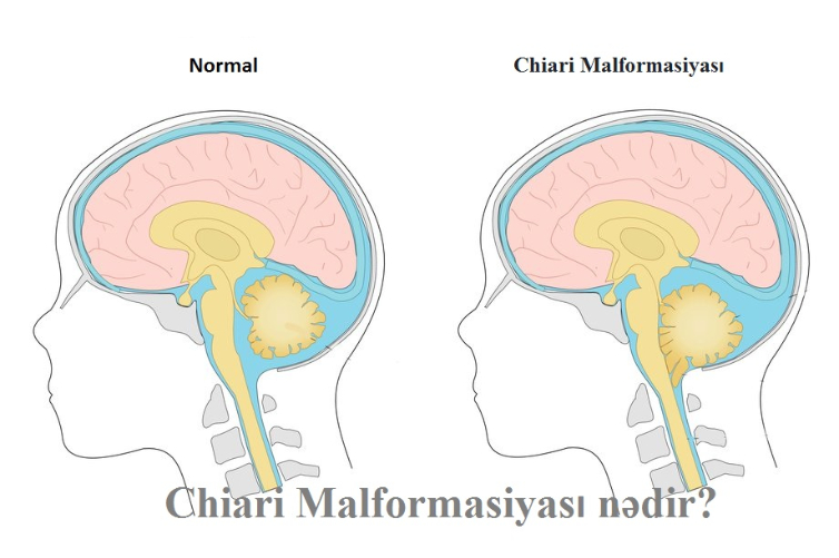 Chiari Malformasiyası nədir?