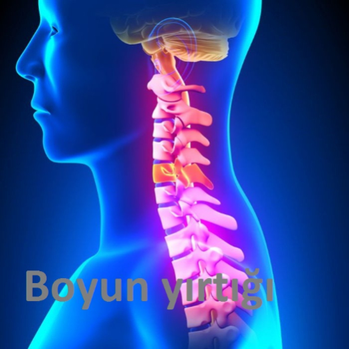 Boyun yırtığı.