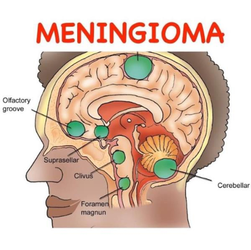 Менингиома это. Доброкачественная опухоль головного мозга менингиома. Менингиома расположение.