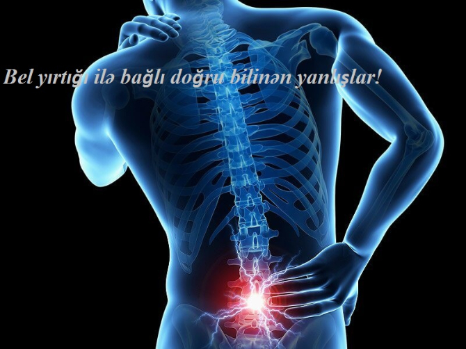 Bel yırtığı ilə bağlı doğru bilinən yanlışlar!