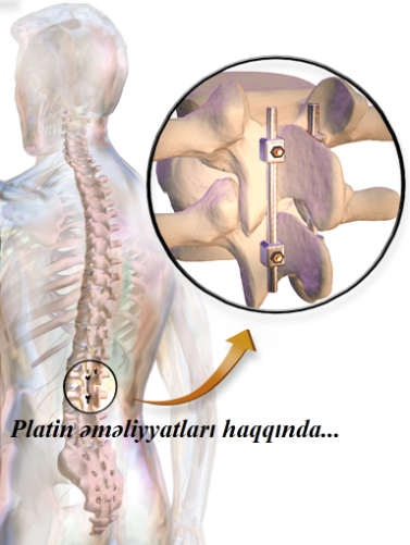 Onurğa implantı əməliyyatları haqqında...