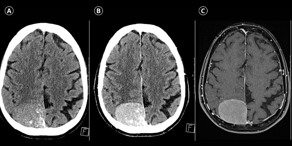 Meningioma beynin xoş xassəli şişi