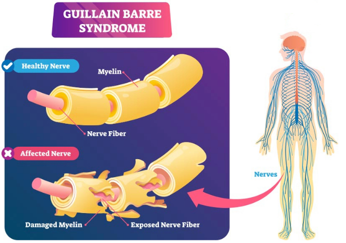 Guillain-Barre Sindromu