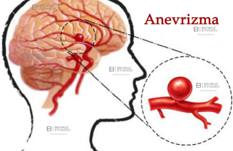 Anevrizma nədir?