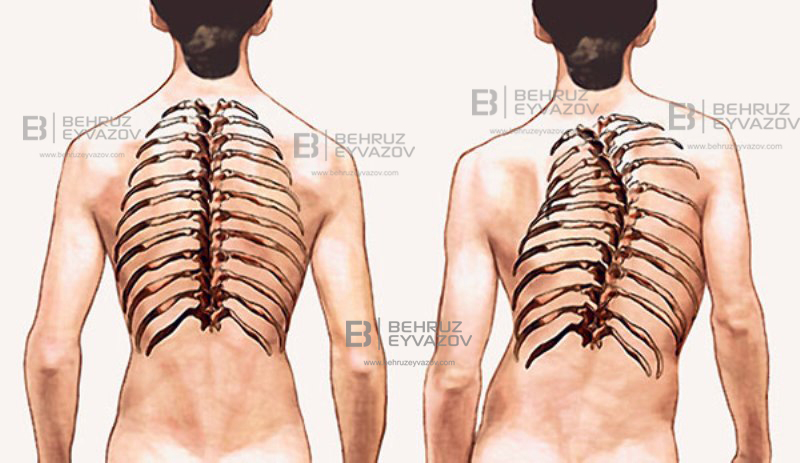 Skolioz xəstəliyinin simptomları və müalicəsi- VİDEO