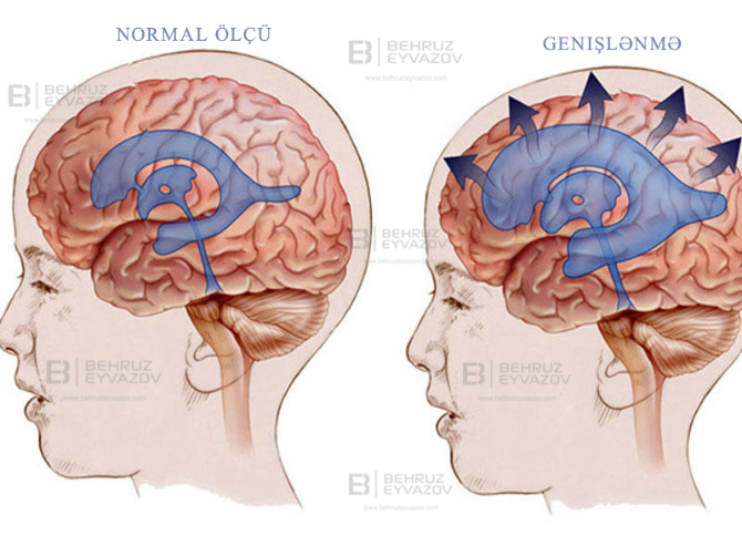 Endoskopik Hidrosefali Cərrahiyyəsi