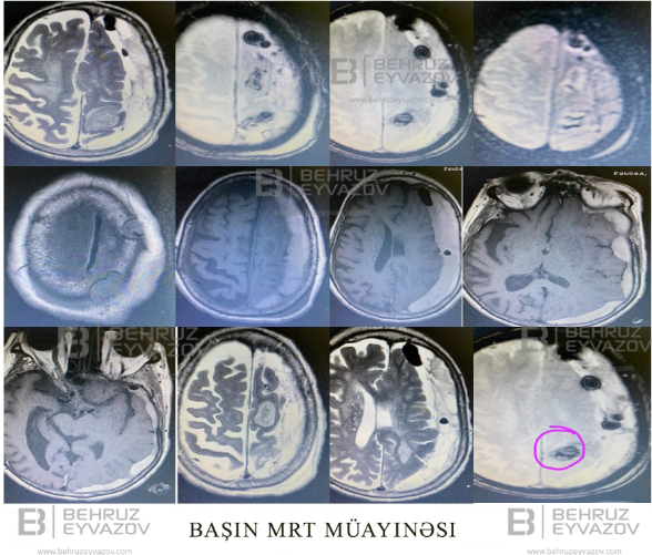 Xroniki subdural hematoma əməliyyatı