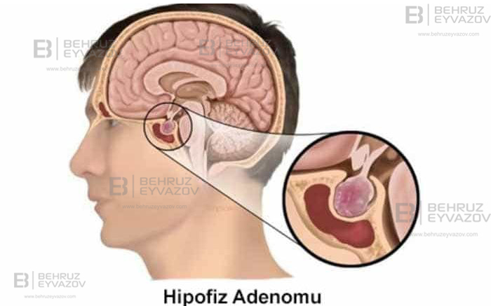 Hipofiz adenoması - VİDEO