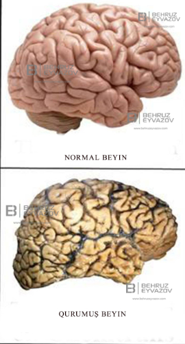 Beyin quruması və onun əsas səbəbləri - VİDEO