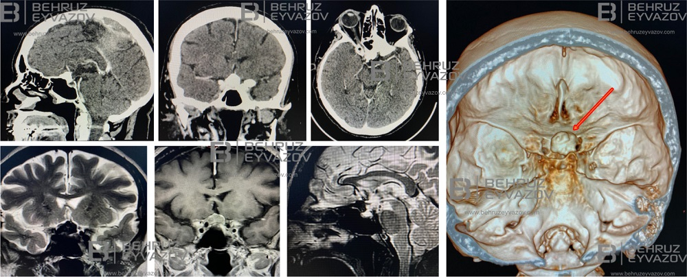 Planum sphenoidale meningioma-Əsas sümüyün yamacının meningioması 