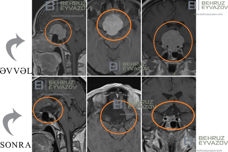 Planum Sphenoidale meningioma: əməliyyatdan sonrakı sağalma prosesi