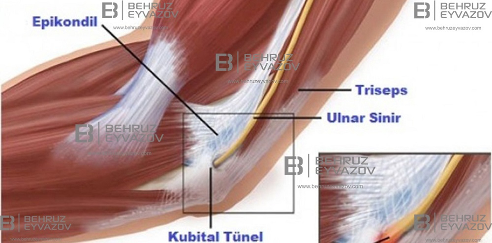 Kubital tunel sindromunun müalicəsi - VİDEO