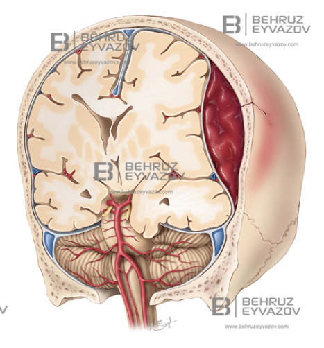 Epidural Hematom: Əlamətlər, Diaqnoz və Müalicə Yolları