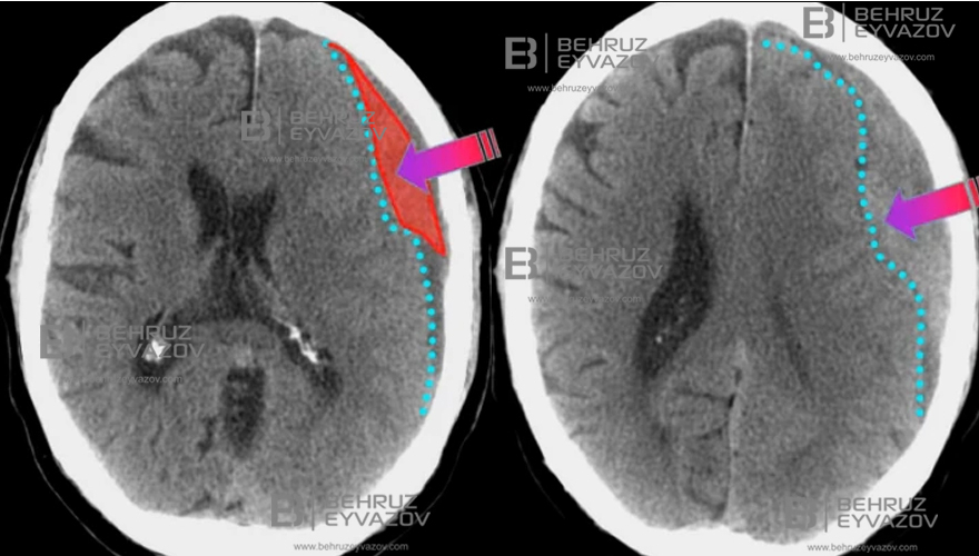 Xroniki Subdural Hematoma: Travma sonrası gecikmiş risk