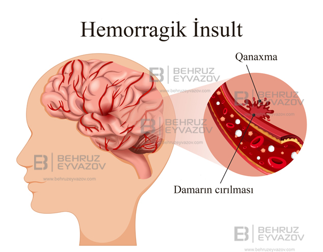 Hemorragik İnsult: Səbəbləri, Əlamətləri və Müalicəsi