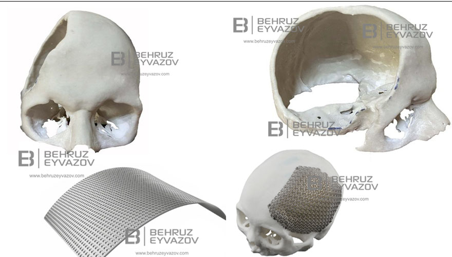 Kəllə Sümüyü Defektlərinin Titan Materialı ilə Bərpası