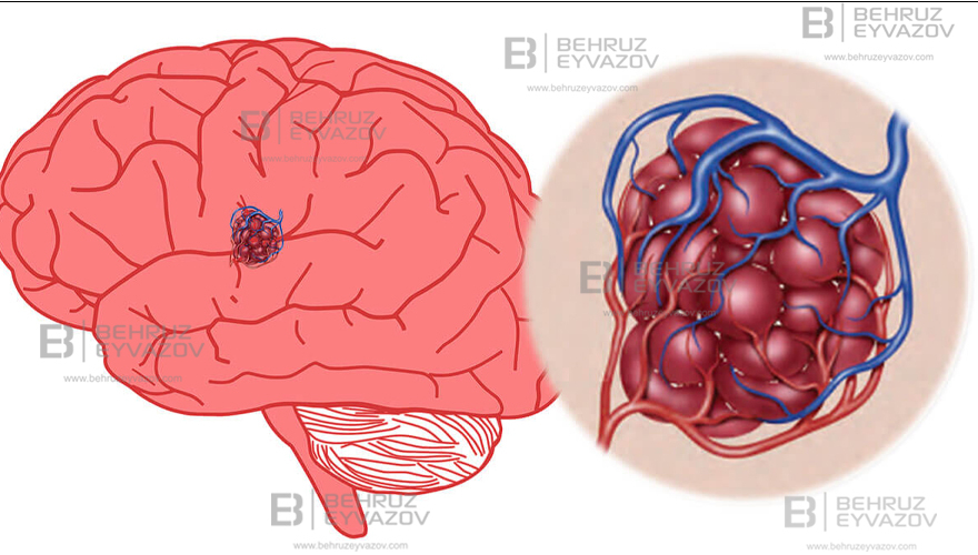 Kavernoma: Epileptik Tutmalar və Kəskin Baş Ağrıları