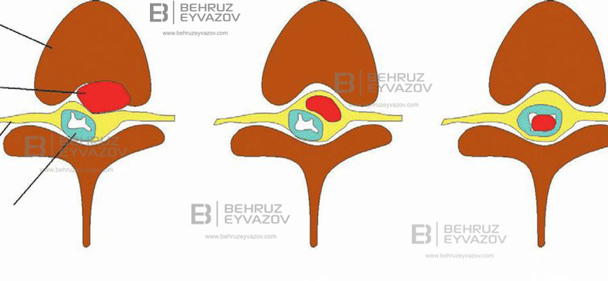 Onurğada intradural şiş və onun müalicəsi